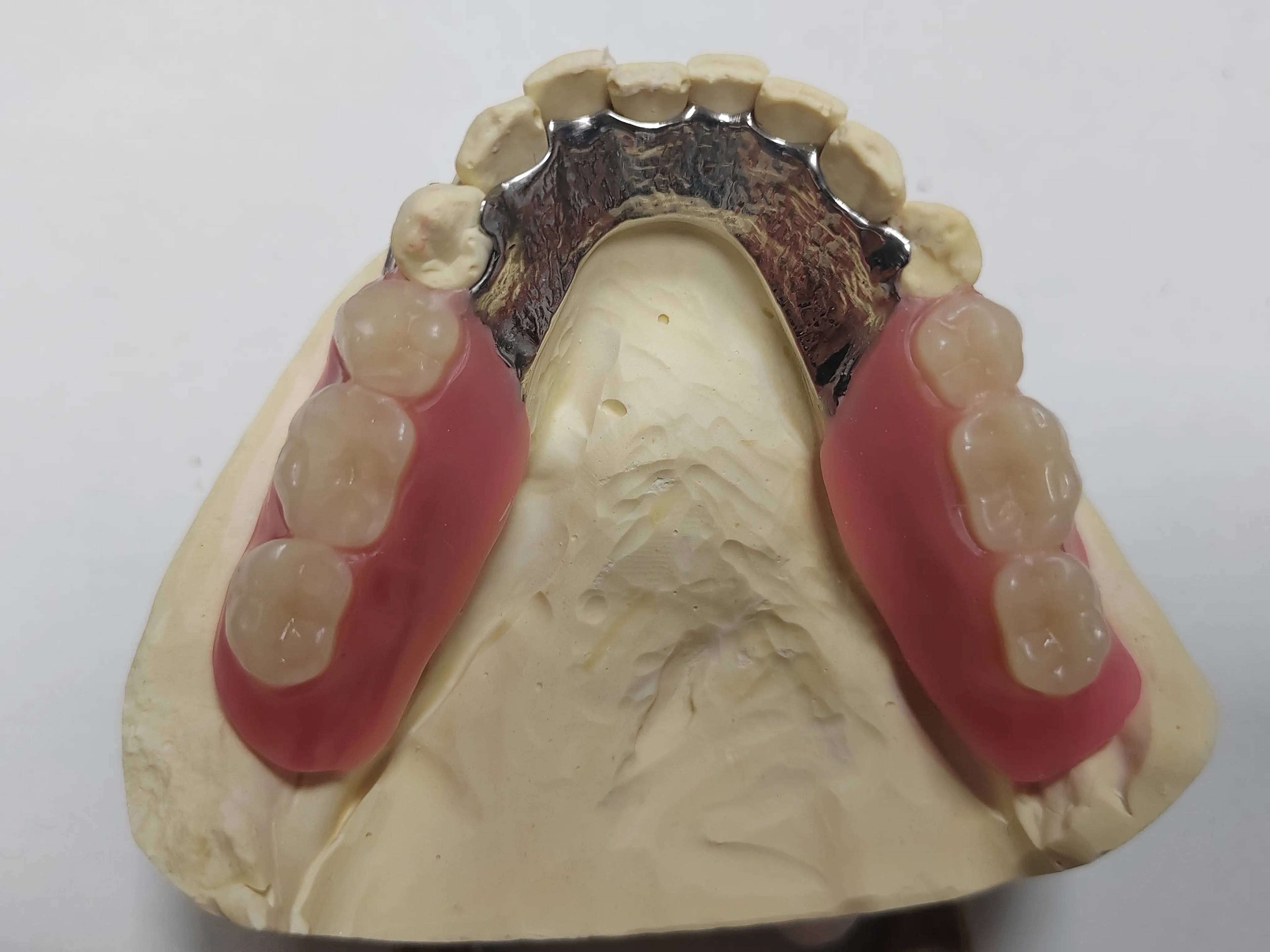Removable Partial Denture