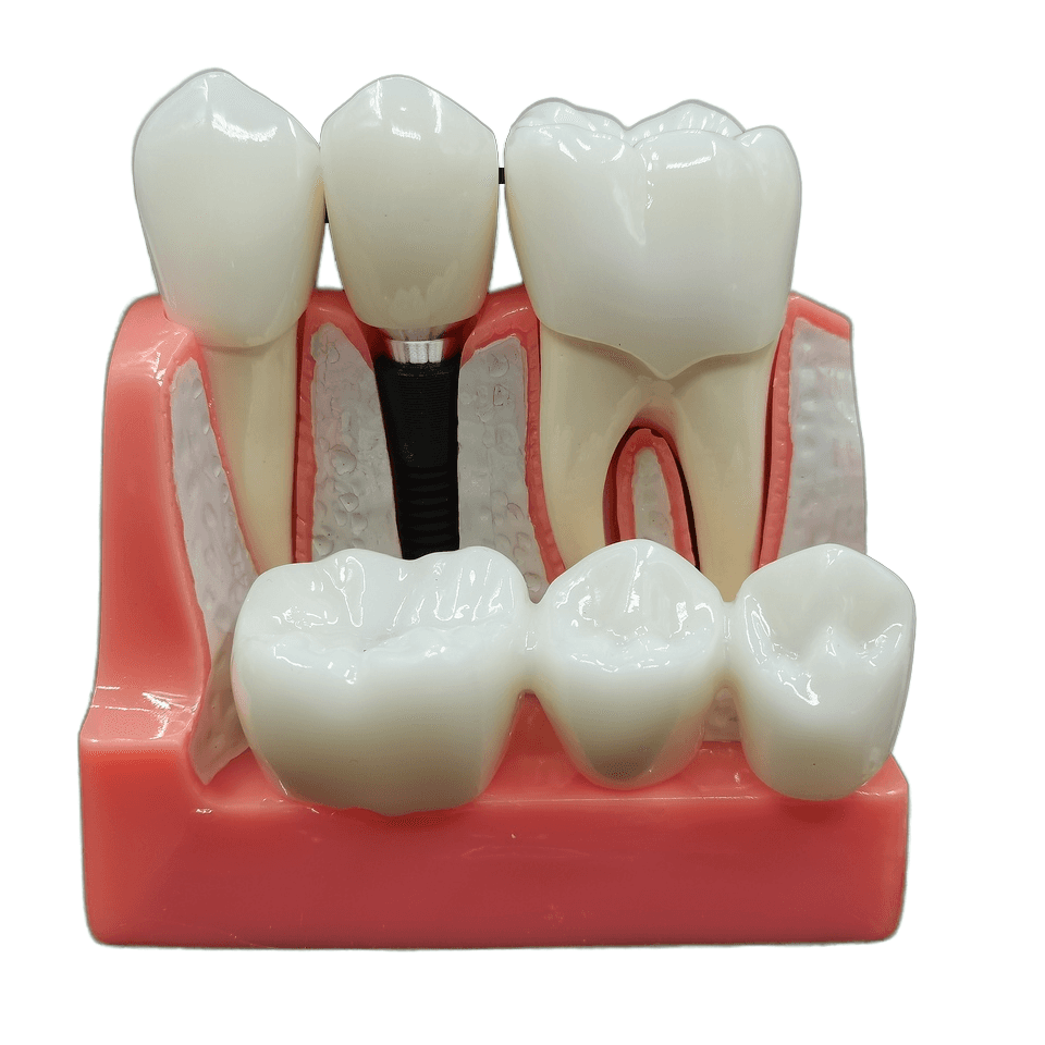 Dental Implant Model 2.5 Times Dental Implant Demonstration Models Crown Bridge Abutment Removable Dentistry Clinic Tools