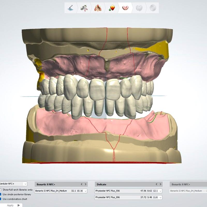 Design Abutment & Crown