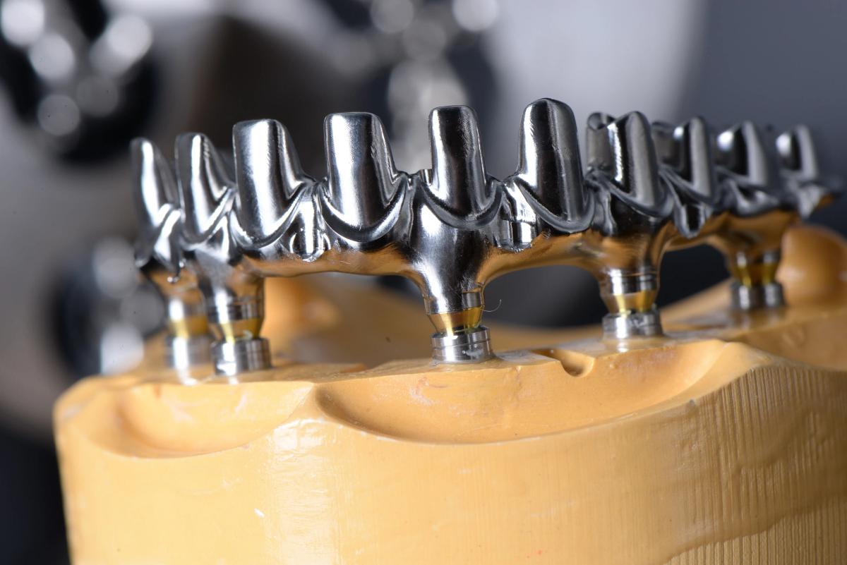 Removable Partial Denture: Modern Dental Solution for Missing Teeth