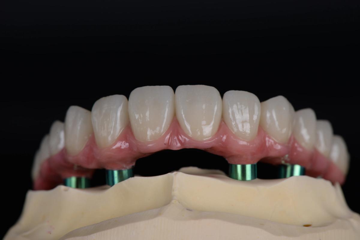 Removable Partial Denture: Ultimate Guide to Comfort & Fit