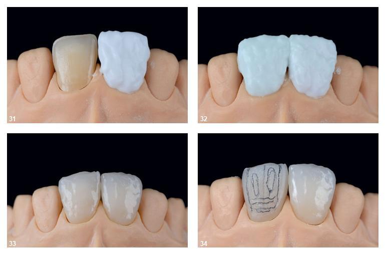 Fornitore di faccette dentali: soluzioni estetiche di alta qualità per faccette dentali
