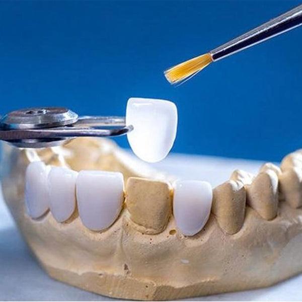 E.max Veneers Dental Lab: Natural Translucency and Precision Smile Design Solutions